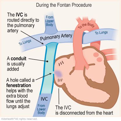 The Fontan Procedure | Rady Children's Hospital