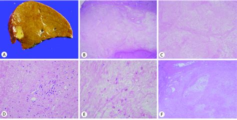 Gross Photo And Microscopic Features Of Resected Hepatic Lesion A Download Scientific