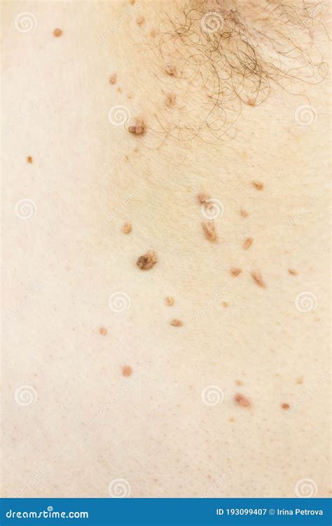 Papilloma Virus in the Armpit of a Man, a Dermatological Problem, the Concept of Skin Disease ...