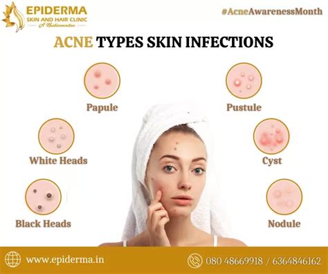 Ppt Acne Types Best Acne Treatment In Jayanagar Bangalore Epiderma Clinic Powerpoint