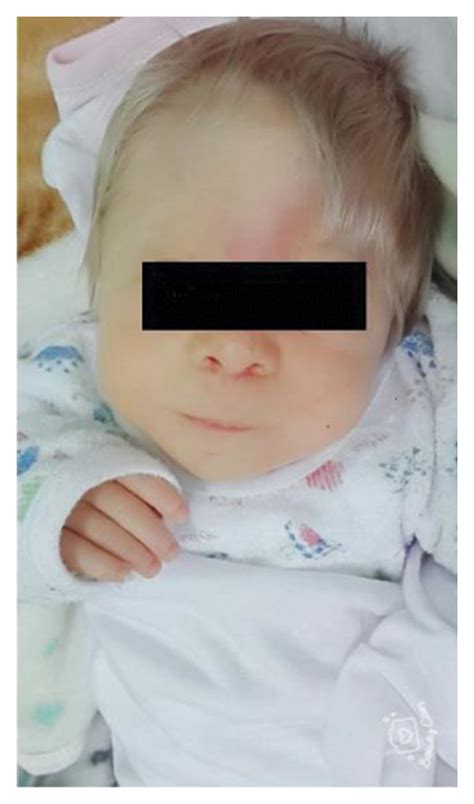 Trigonocephaly, hypotelorism, depressed nose bridge, and long philtrum ...