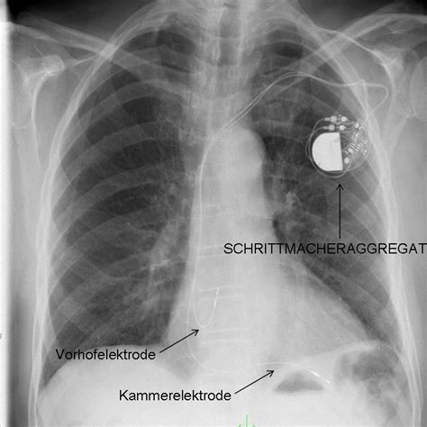 Implantationen Uniklinik Mannheim