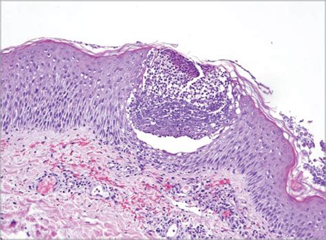 Acute Generalized Exanthematous Pustulosis Induced By Sorafenib