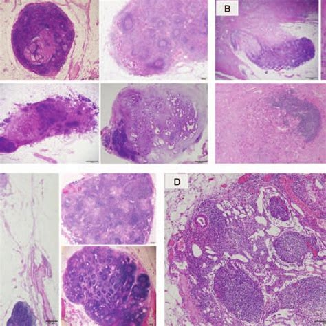 Classification Of Lymph Node Ln Metastasis A Common Type B Download Scientific