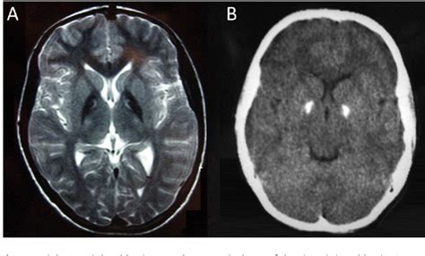 Basal ganglia calcification in a case of PKAN. | Semantic Scholar