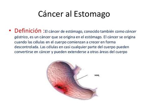 Cancer De Estomago