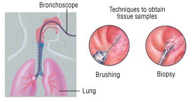 Flexible Bronchoscopy