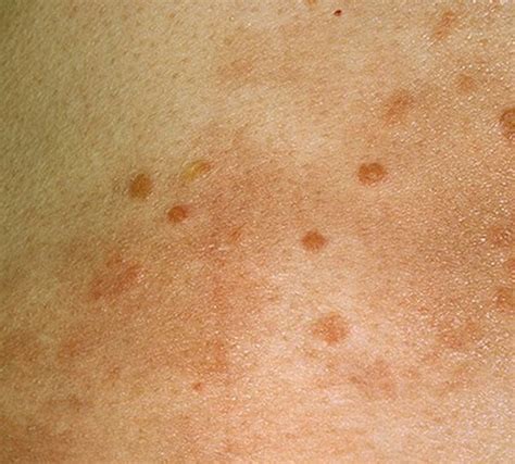 Hiv Rash Symptoms Pics And Treatment 2018 Updated