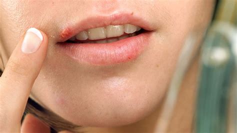 What Can Cause Rash On Lips