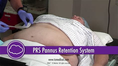 TZ Medical Pannus Retention System Application - YouTube