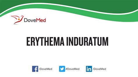 Erythema Induratum - DoveMed