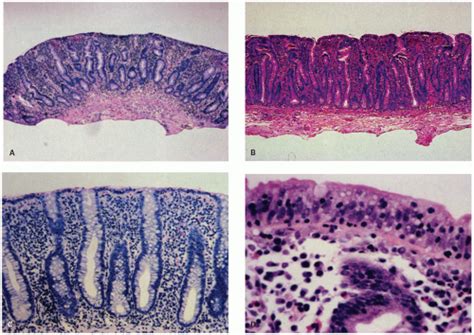 Small Bowel Mucosal Disease Abdominal Key