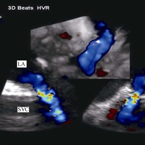 Sinus Venosus Atrial Septal Defect A Transthoracic Echocardiogram