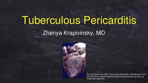 Tb Pericarditis