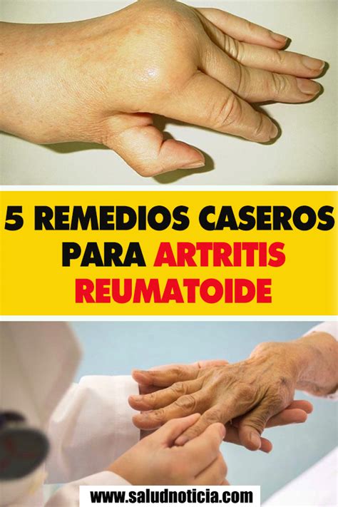 Remedios Caseros Para Artritis Reumatoide Thumbs Up