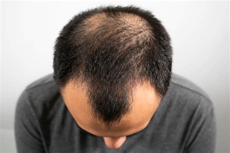 How To Know If Your Hair Loss Is Permanent Sl Aesthetic Clinic