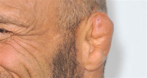 Cauliflower Ear Symptoms Causes And Treatment