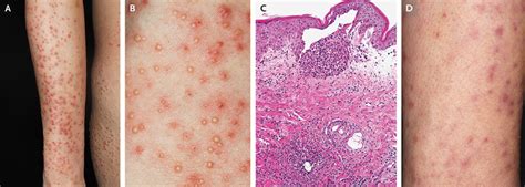 Dermatitis During Pregnancy