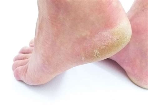 Pes Rachado E Ressecado - Melhor creme para pés ressecados e rachados. Veja 9 opções.