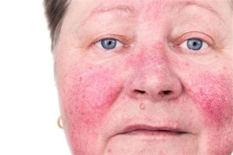 10 Steps To Treat Rosacea At Home Facty Health