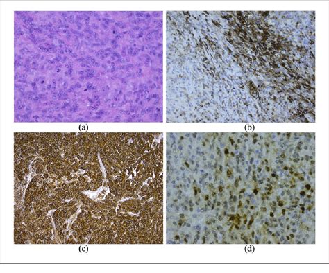 Figure From A Rare Case Of Atypical Anaplastic Meningioma With Mdm