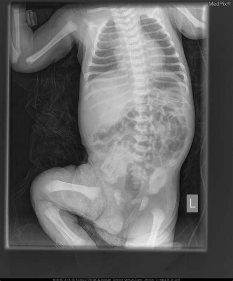 Tracheoesophageal Fistula Ultrasound