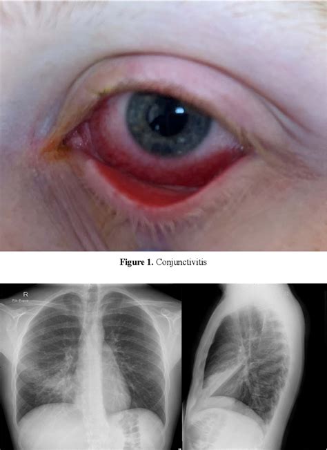 Figure 1 From The Importance Of Distinguishing Mycoplasma Pneumoniae