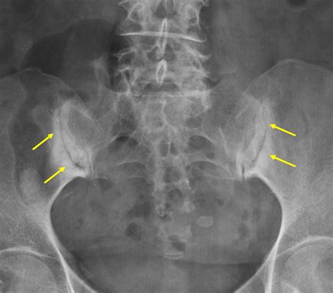 Sacroiliatis Radiology Cases