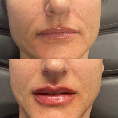 Lip Filler Cedar Park TX AustinMD AustinMD Aesthetics Wellness