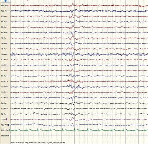 Eeg Test Results