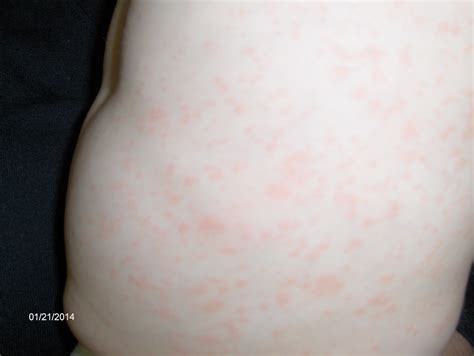 Roseola Rash Fever Urgent Care Pediatrics Dr Phillips 32819 Urgent