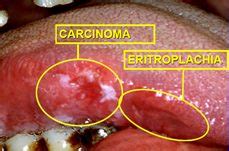 Leritroplachia Bald Mountain Science