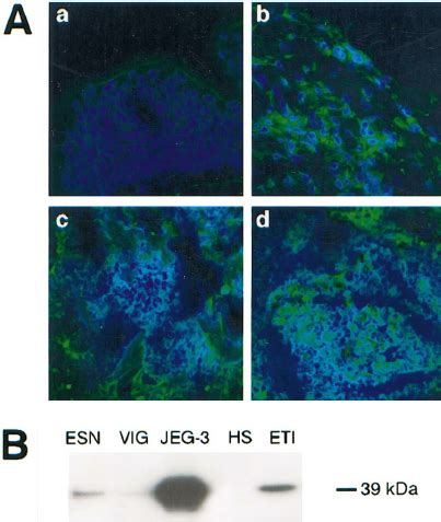 Confocal Microscopy Analysis Of HLA G Expression In Melanoma Biopsies