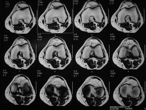 Osteochondritis Dissecans Image