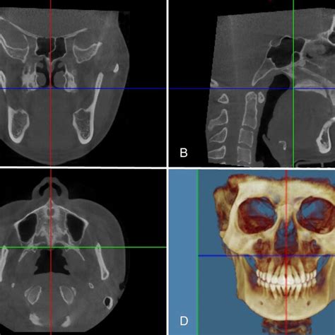 Three Dimensional View A Coronal Slice B Sagittal Slice C