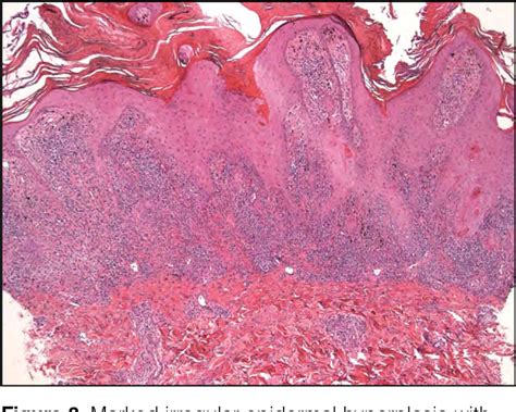 Figure 3 From Lichen Planus Mimicking Recalcitrant Ulcerative Psoriasis