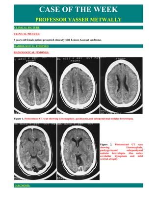 Case record...Cortical dysplasia | PDF