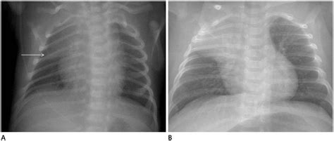 Interpretation Of Neonatal Chest Radiography