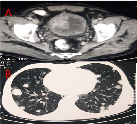 Metastatic Adenocarcinoma Of Bladder Presenting With Skin And Visceral