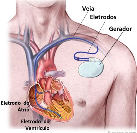 Implante De Dispositivos Card Acos Como Evitar E O Que Fazer Diante De