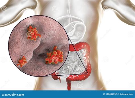 Entamoeba Histolytica Protozoan Infection Of Large Intestine Coloso