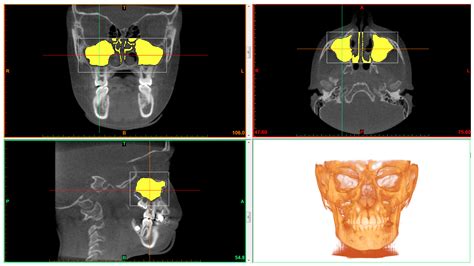 Materials Free Full Text Three Dimensional Evaluation Of Maxillary