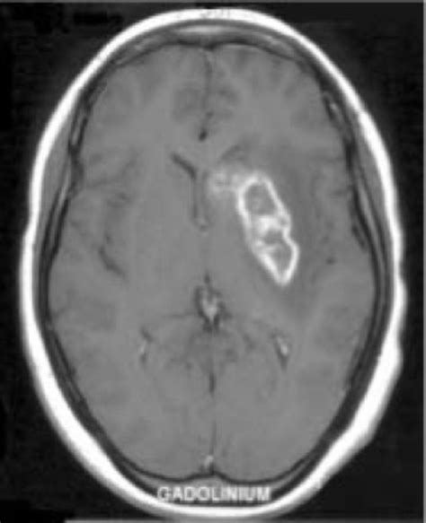 Neurosyphilis In Patients With Hiv Practical Neurology