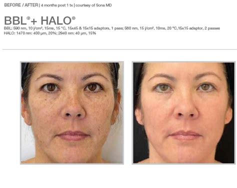 Halo Laser Skin Resurfacing in Dallas | Sanjiva Medical Spa