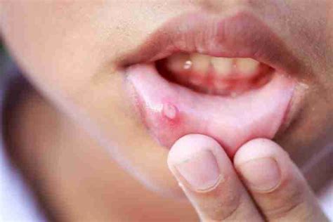 How To Identify Oral Cancer Vs Canker Sore