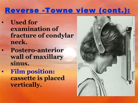 Extra Oral Radiology Techniques Ii Ppt