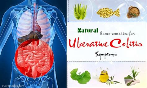 25 Home Remedies For Ulcerative Colitis Symptoms