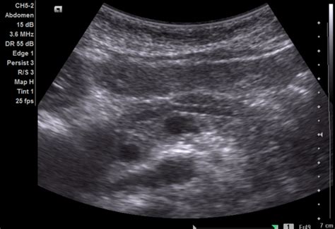 Dilatation Of The Common Bile Duct Radiology Case