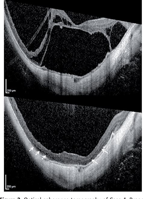 Figure From Pars Plana Vitrectomy With Internal Limiting Membrane