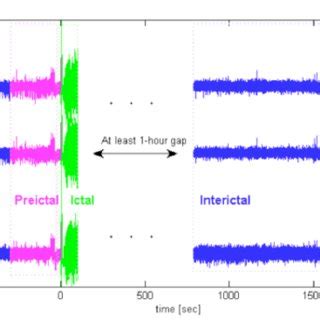 Seizure recorded with EEG. Ictal (seizure) event shown in green, is... | Download Scientific Diagram